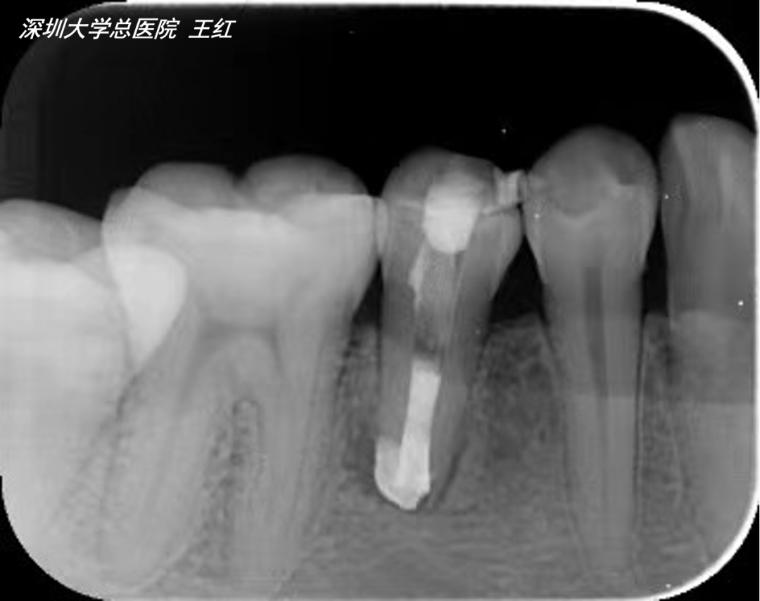 根尖片的正常图像及常见片位的正常图像及应用