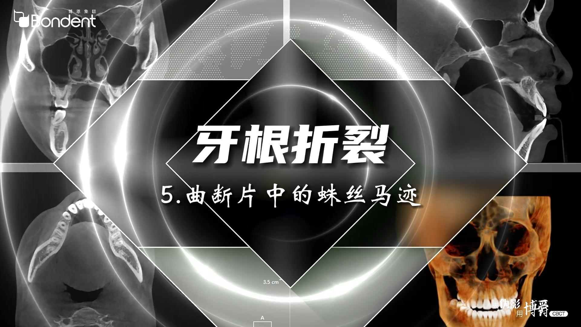 5-牙根折裂-曲断片中的蛛丝马迹——博爵牙科CT口腔医学影像基础诊断