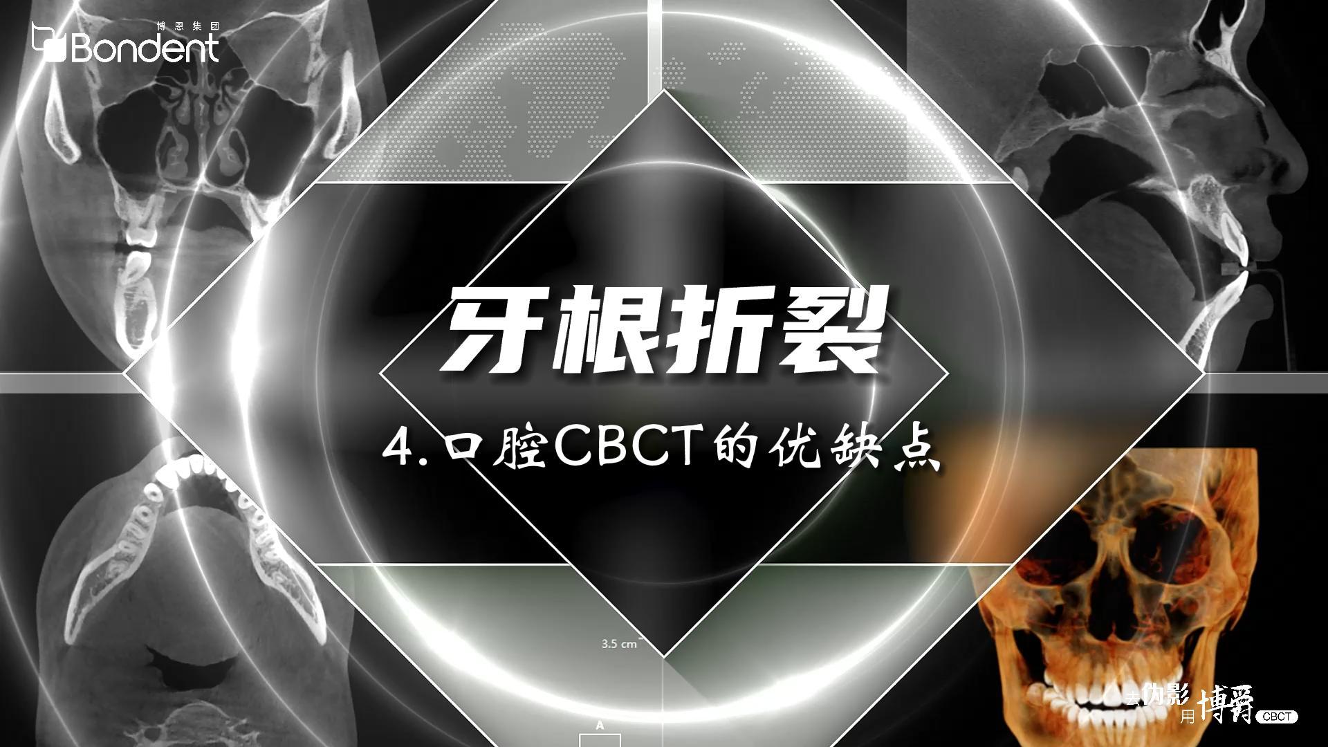 4-牙根折裂-口腔CBCT的优缺点——博爵牙科CT口腔医学影像基础诊断