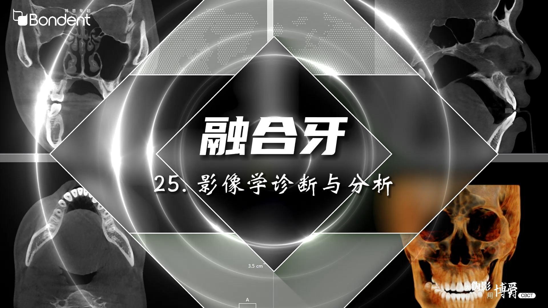 25-融合牙-影像学诊断和分析——博爵牙科CT口腔医学影像基础诊断