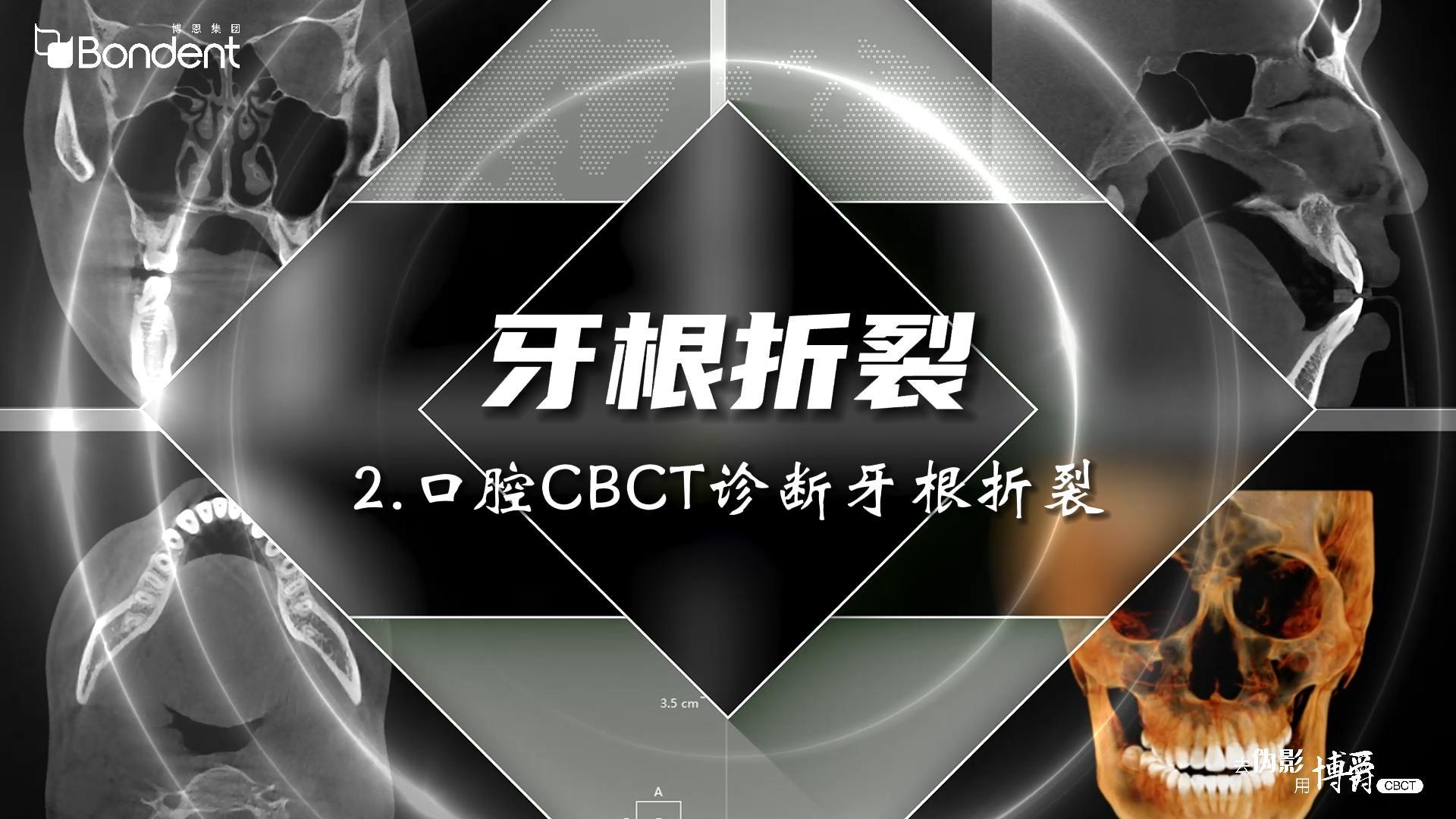 2-牙根折裂-口腔CBCT诊断牙根折裂——博爵牙科CT口腔医学影像基础诊断