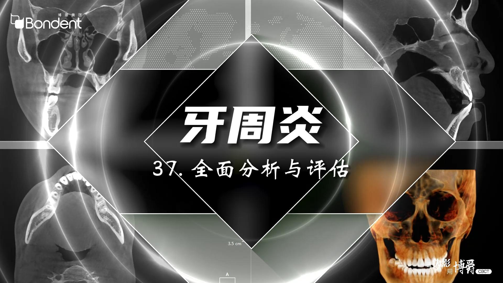 37-牙周炎-全面分析与评估——博爵牙科CT口腔医学影像基础诊断