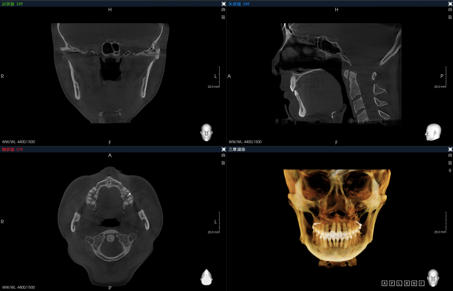 博爵云晰1070大视野智能口腔CBCT