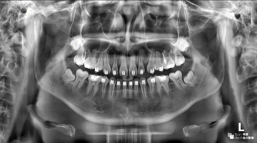 博爵云晰1070大视野智能口腔CBCT
